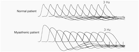 Image result for Repetitive Nerve Stimulation Test