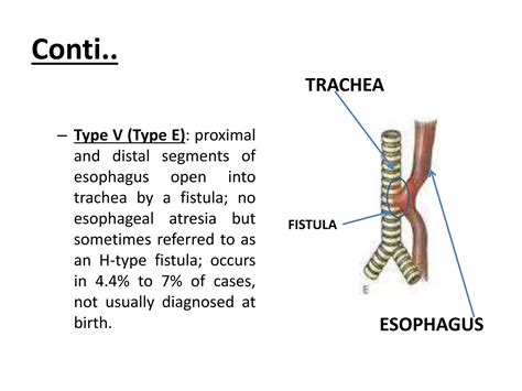 Tracheoesophageal fistula | PPTX