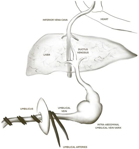 Umbilical Vein Varix
