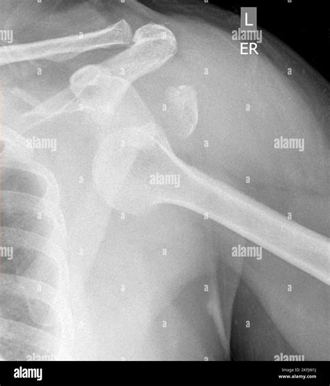 X-ray of a dislocated shoulder. This is an inferior dislocation with a ...