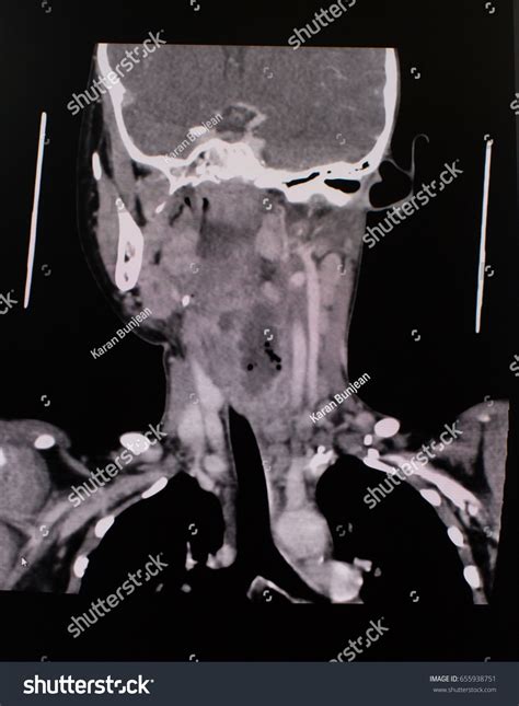 Coronal Frontal View Ct Scan Neck Stock Photo 655938751 | Shutterstock