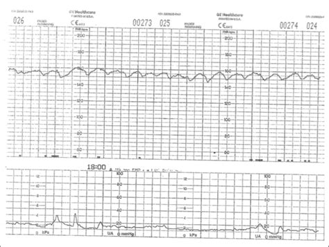 Intermittent Sinusoidal Fetal Heart Rate and Massive Maternal-Fetal ...