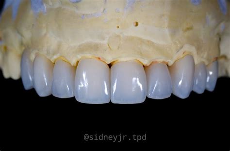 Lentes e Facetas dentais - Laminados cerâmicos | Dental, Dental lab, Food