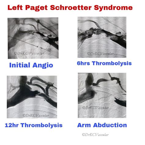 Krishna Chaitanya K H on LinkedIn: Left Paget Schroetter Syndrome