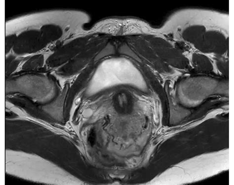 Philips - mDIXON XD TSE - Pelvis MR clinical application - Philips