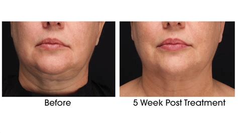 Image result for Profound Face Procedure