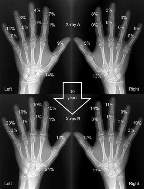 Natural history of radiographic features of hand osteoarthritis over 10 ...