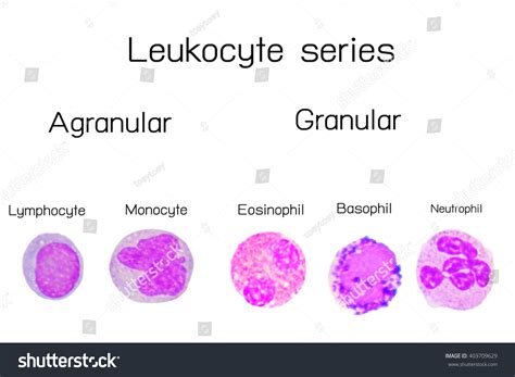 High B12 High Eosinophil Low Neutrophil-medical