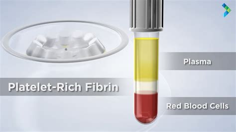 PRF|PLATELET RICH FIBRIN|PRP|PLATELET RICH PLASMA|STICKY, 59% OFF