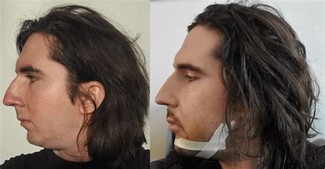 Mandible Lower Jaw: BSSO + Sliding Genioplasty (20mm) and Maxilla Upper ...