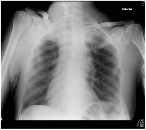 Dental Prosthesis in Esophagus: A Right Cervicotomic Approach