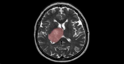 How virus infection is linked with progress of brain cancer - IBTimes India