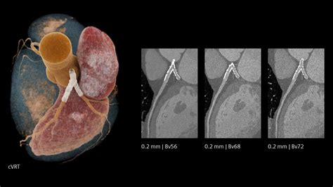 PCCT cardiovascular imaging - Siemens Healthineers