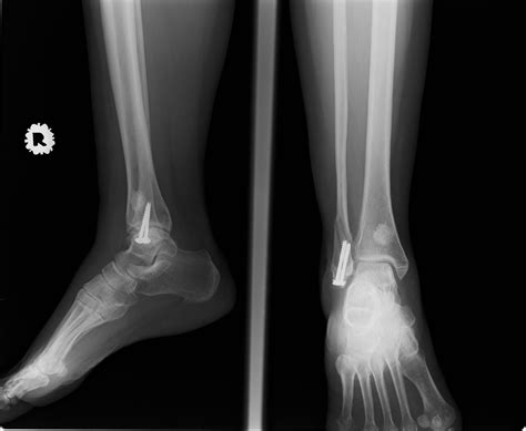 Cpt Code For Closed Treatment Of Distal Fibula Fracture With Manipulation at Joshua Hausman blog