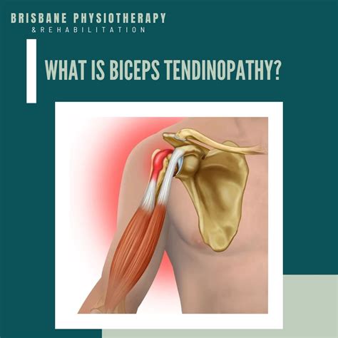 What is Biceps Tendinopathy? - Brisbane Physiotherapy & Podiatry