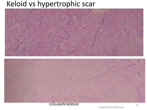 Discuss keloid and hypertrophic scars | PDF