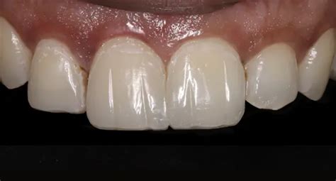 Teeth Veneers in Margao- Smile Craft Goa