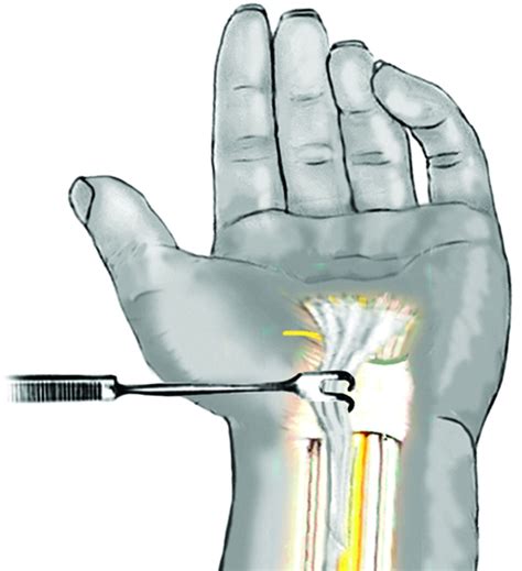 Transverse Carpal Ligament
