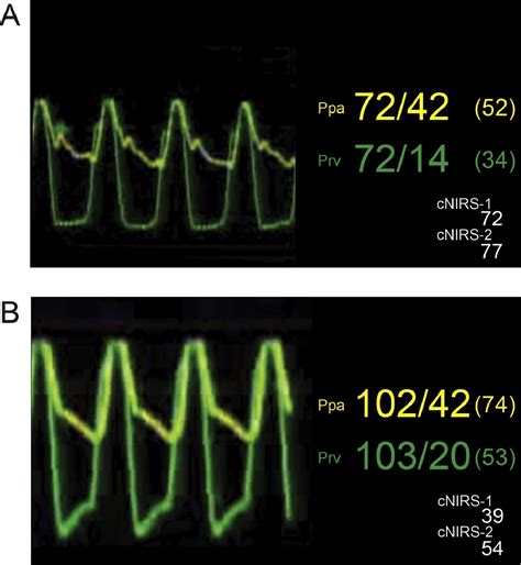 Perioperative Right Ventricular Pressure Monitoring in Cardiac Surgery ...