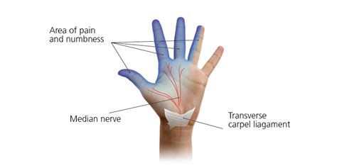 Carpel tunnel syndrome (CTS) in pregnancy - South Tees Hospitals NHS ...