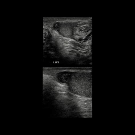 Pediatric Appendix Testis Torsion and Appendix Epididymis Torsion | Pediatric Radiology ...