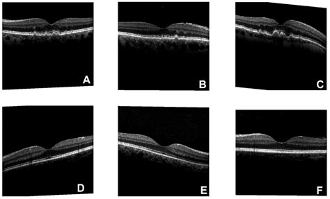 Fusion Learning Methods for the Age-Related Macular Degeneration ...