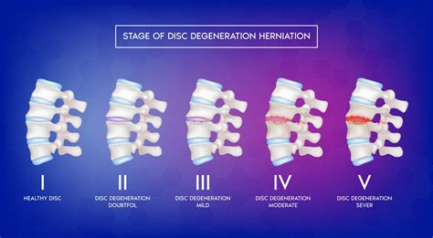 Multilevel Disc Desiccation
