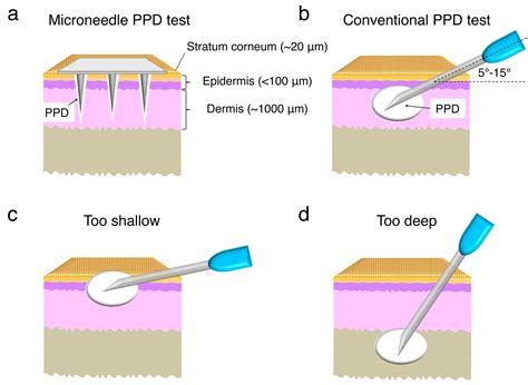 Replacing Standard Tuberculosis Skin Test - Today's Medical Developments