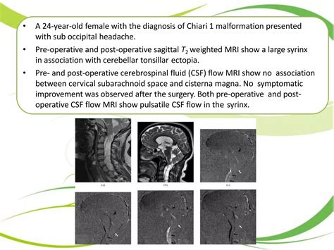 CSF Flow Study MRI 的图像结果