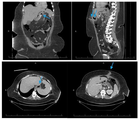 JCM | Special Issue : Sleeve Gastrectomy: Risks, Outcomes, and ...