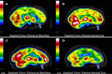 Depression Brain Scan
