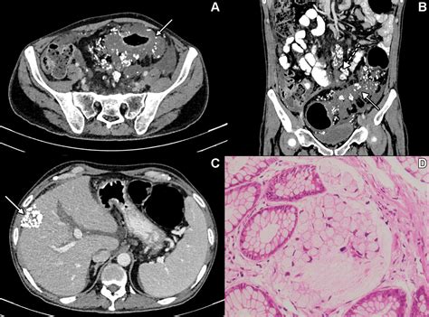 Calcified Primary Signet Ring Cell Carcinoma of the Colon with Metastases | Radiology: Imaging ...