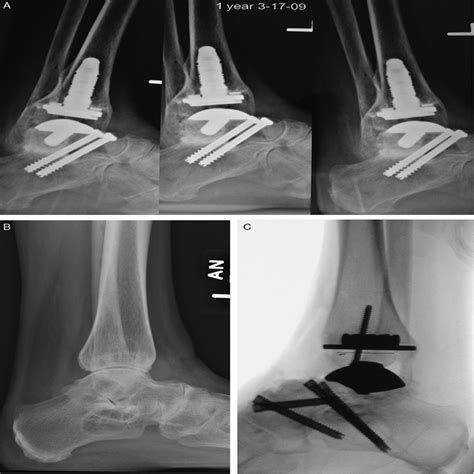 Total Ankle Replacement With Subtalar Arthrodesis: Managemen ...