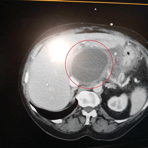 My mother has a cyst the size of her stomach, this is her MRI. It is on the pancreas, and she ...
