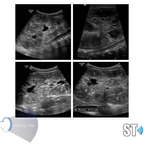 Normal Vs Abnormal Kidney Ultrasound Figure 1.