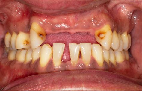 Gum disease symptoms and treatment - The Implant Experts