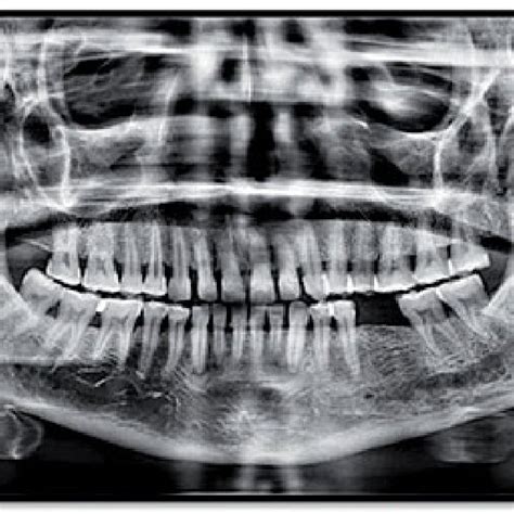 Image result for Functionality of the Styloid Process of Temporal Lobe