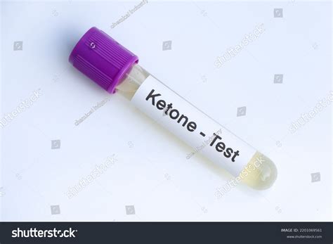 Lab Results Ketones In Urine at Norman Nelson blog