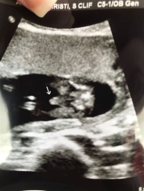 16 Week Ultrasound Boy