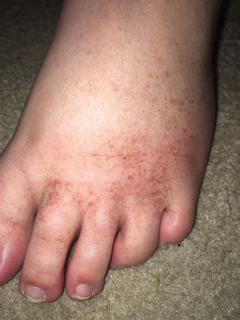 My brother (14yo) told me these spots have been appearing over the last ...
