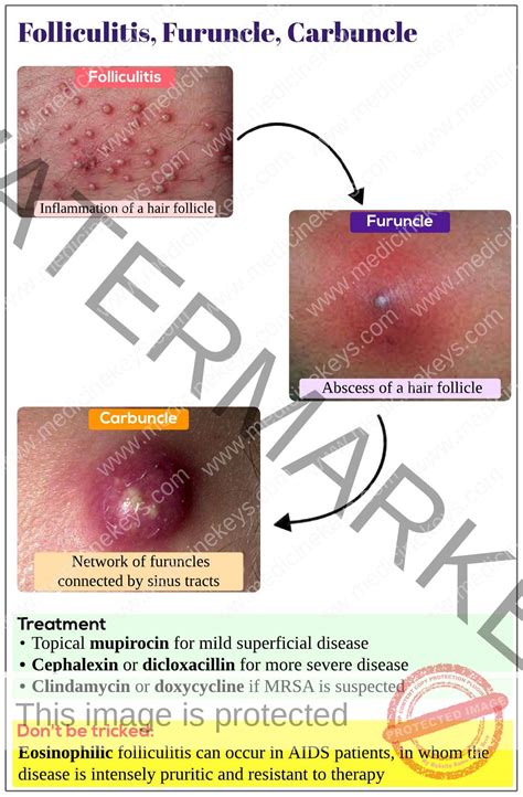 Best Antibiotic For Hot Tub Folliculitis at Joseph Shupe blog