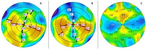 Managing Post-Keratoplasty Astigmatism: High-Tech vs. Low-Tech Imaging ...