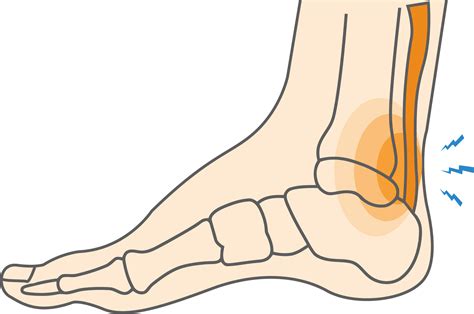 Achilles Tendon Pain