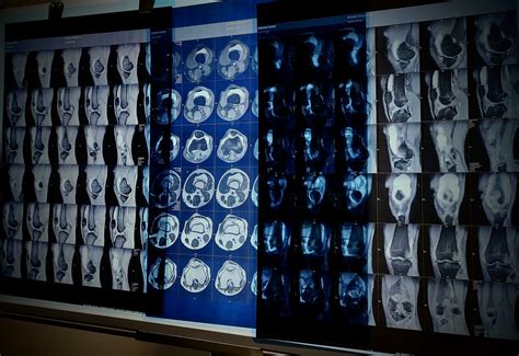 Acl Tear :) | Medical technology, Medicine, Medical tests