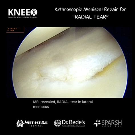 KNEEO (@kneeofoundation) • Instagram photos and videos