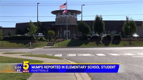 Mumps Confirmed In Fayetteville Elementary School Student; Immunization ...
