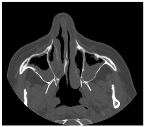 Identification and Characterization of Nasal Polyposis and Mycoplasma ...