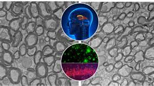 Could Lithium Deficiency In The Brain Trigger Alzheimer’s?