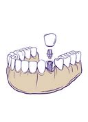 Dental Implants Types, Procedure & Cost in India | Dezy