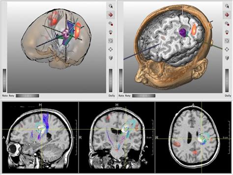 Image result for MeVisLab Fiber
